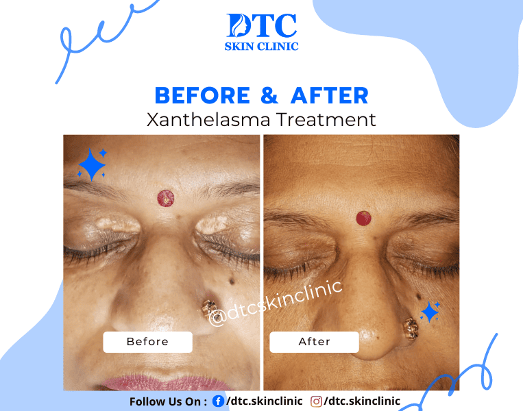 Before and after hair treatment result